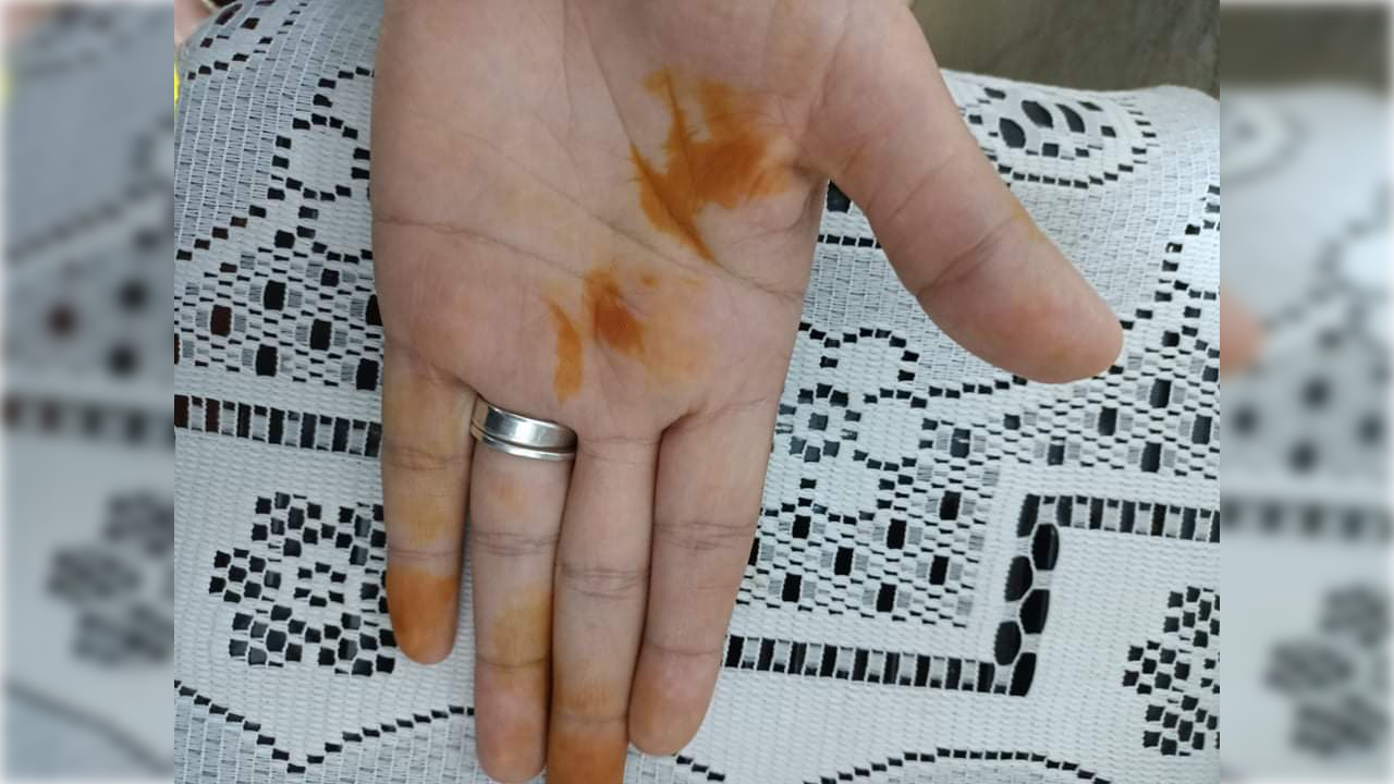 أسباب ظهور الحناء على اليدين.. بعضها صادم
