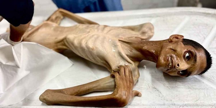 شاب من رفح يفارق الحياة بسبب المجاعة وسوء التغذية صور مؤلمة