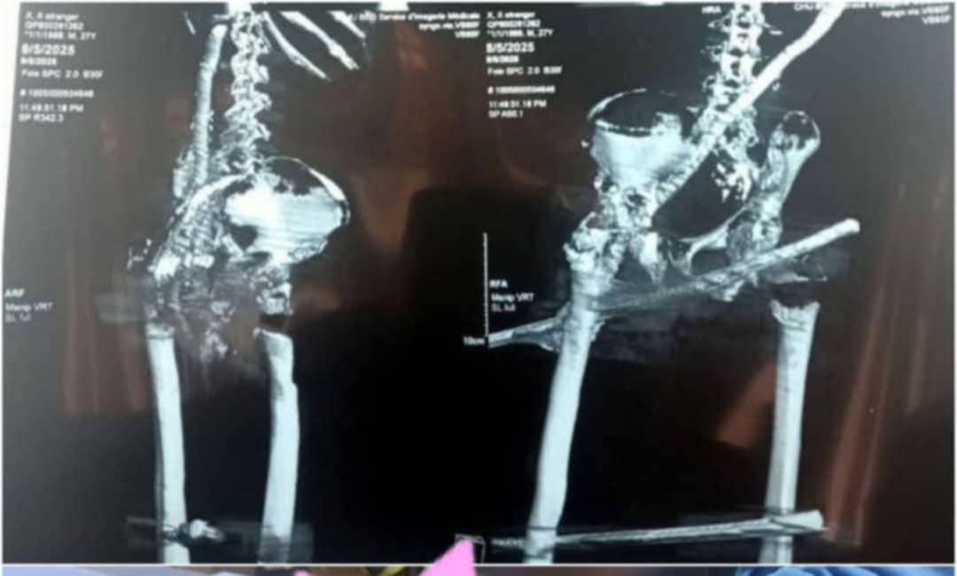 نجاة عامل غيني بأعجوبة بعد اختراق 3 قضبان حديدية لجسده في العاصمة