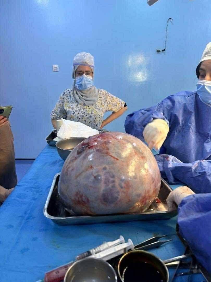 عملية استثنائية في باب الواد.. استئصال ورم ضخم من طفلة عمرها 12 سنة
