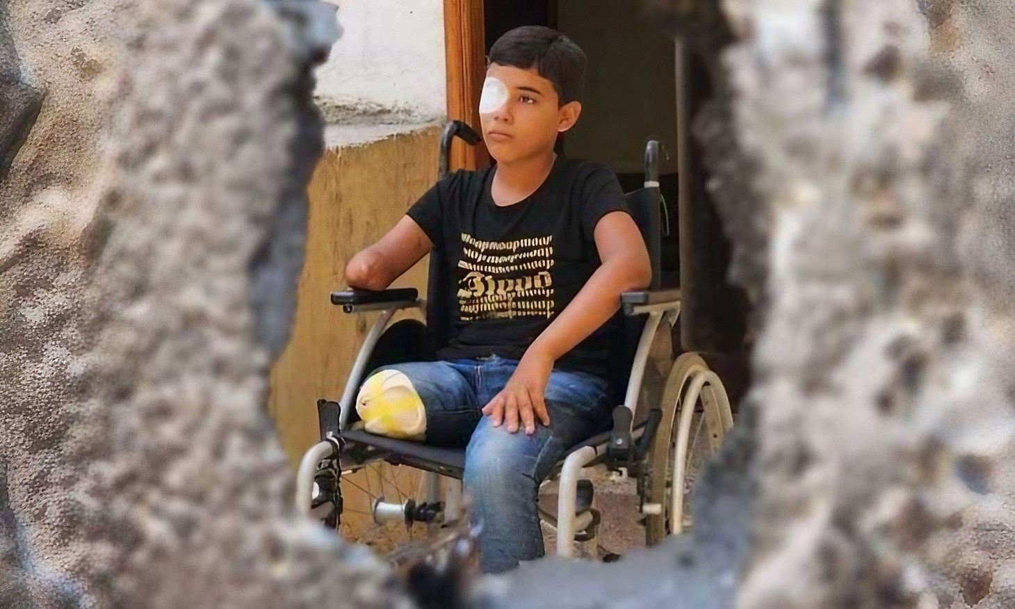غزة: آلاف الأطفال بين بتر الأطراف والإصابات الخطيرة